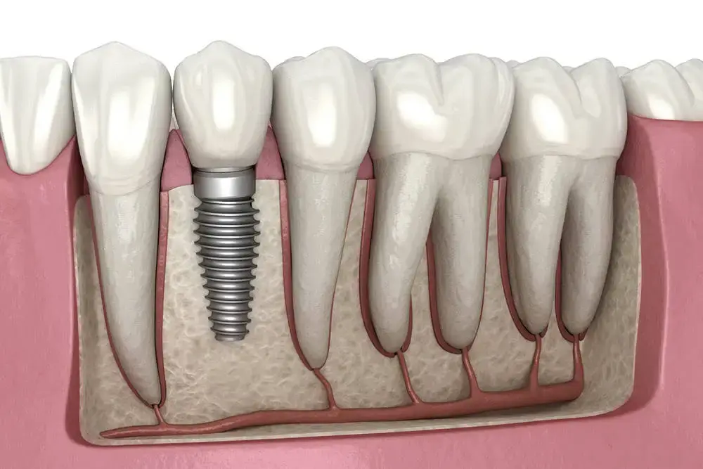 Zubní implantát