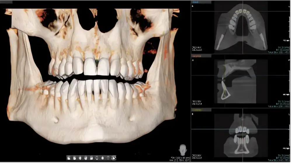 Implantologie- zhotovení 3D snímku