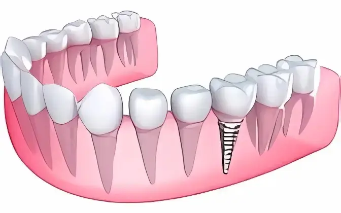 Náhrada jednoho zubu – jeden implantát