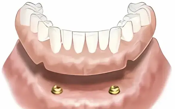 Snímatelná náhrada nesená 2 nebo 4 implantáty.