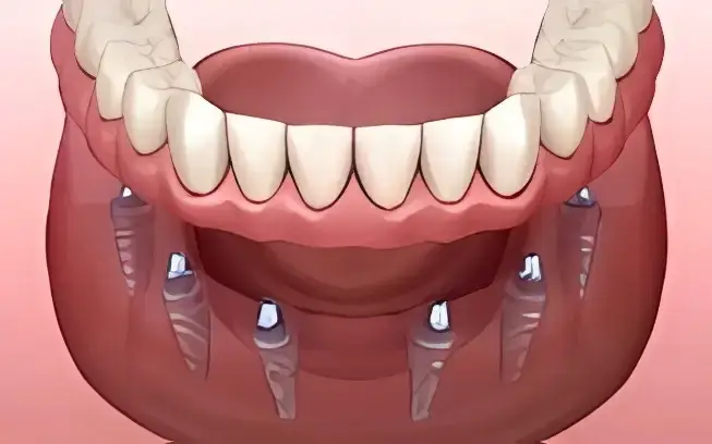 můstek nesený pomocí implantátů